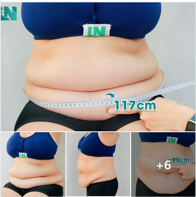 CHỊ KH (36 TUỔI), VÒNG BỤNG LỚN NHẤT LÊN ĐẾN 117CM 