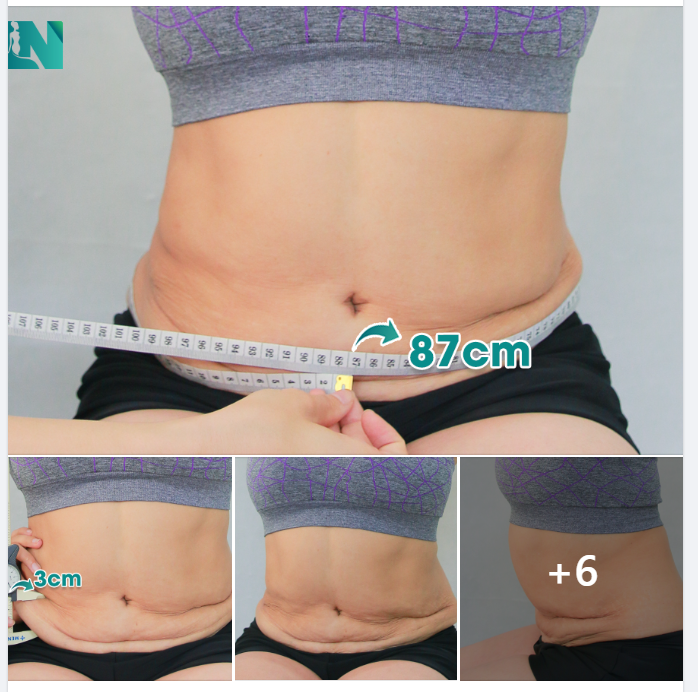CHỊ KH 52 TUỔI, TỪNG CĂNG DA BỤNG NHIỀU NĂM TRƯỚC, SẸO VẪN IN HẰN 