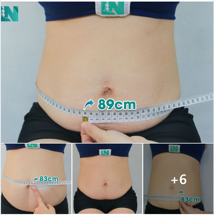 CHỊ KH VIỆT KIỀU MỸ ĐÃ SINH 3 BÉ, TIN TƯỞNG LÀM ĐẸP AN TOÀN. 