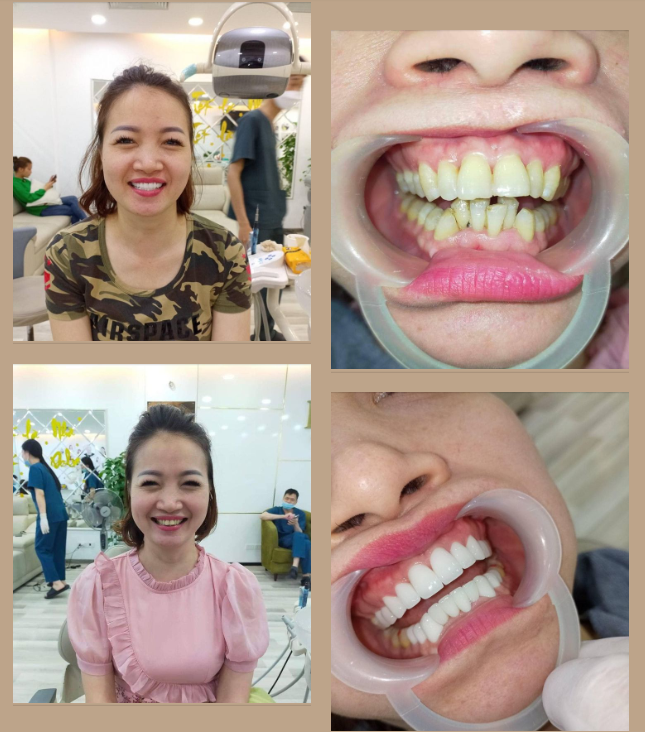 Chị khách hàng xinh gái của nha khoa đã nhận về nụ cười hơn cả mong đợi.