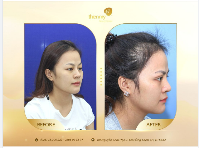 Chị Kim sau khi phẫu thuật Nâng mũi 4-S và Cắt mí!
