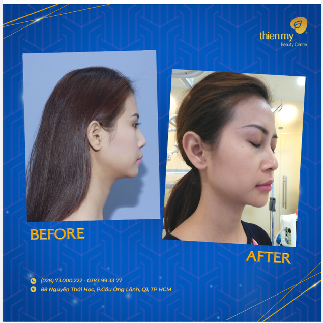 Chị Phương trước và sau khi Nâng mũi 4-S