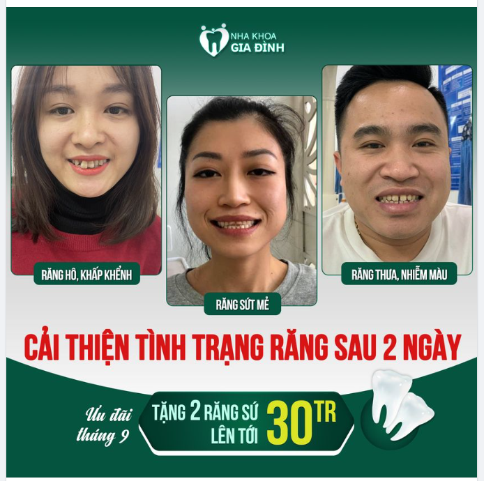 CHỈ SAU 2 NGÀY RĂNG KHÔNG CÒN KHUYẾT ĐIỂM, CẢI THIỆN NHAN SẮC