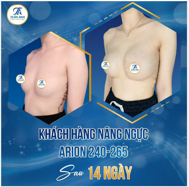CHỈ SAU 60P HÓA '' HAI LƯNG' THÀNH THÂN HÌNH VẠN NGƯỜI MÊ, ĐẸP NGAY SAU 2 TUẦN VỚI TÚI SIÊU NHÁM ARION