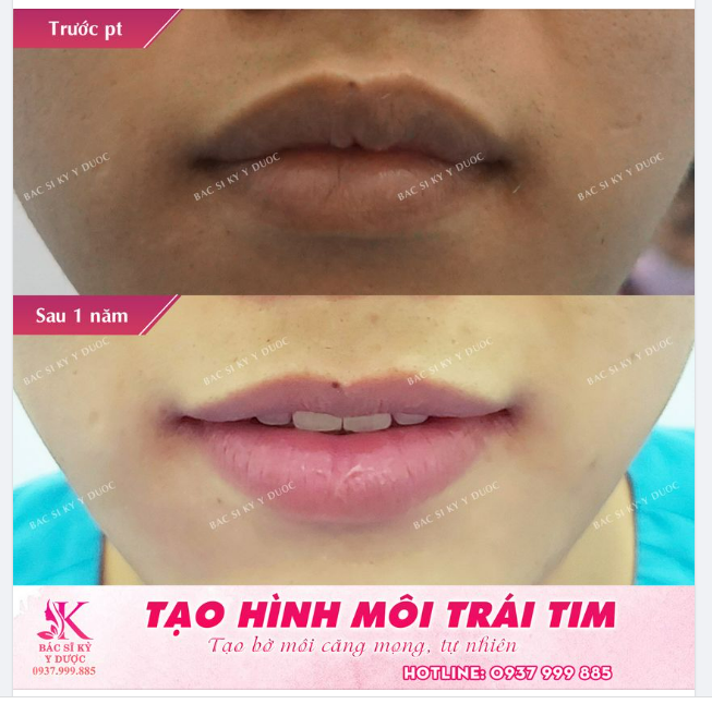 Chỉ với 30 phút phẫu thuật tạo hình môi trái tim