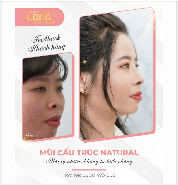 Chia tay lập tức chiếc mũi CŨ nhiều khuyết điểm làm giảm nhan sắc của bạn. Đón nhận dáng mũi MỚI chỉ sau 45 phút biến đổi dung nhan ngoạn mục.