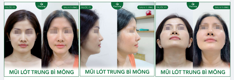 Chiếc mũi cũ của bạn từng nâng bằng sụn tai nhưng chóp mũi quá nhọn khiến mọi thứ trông không vừa ý.