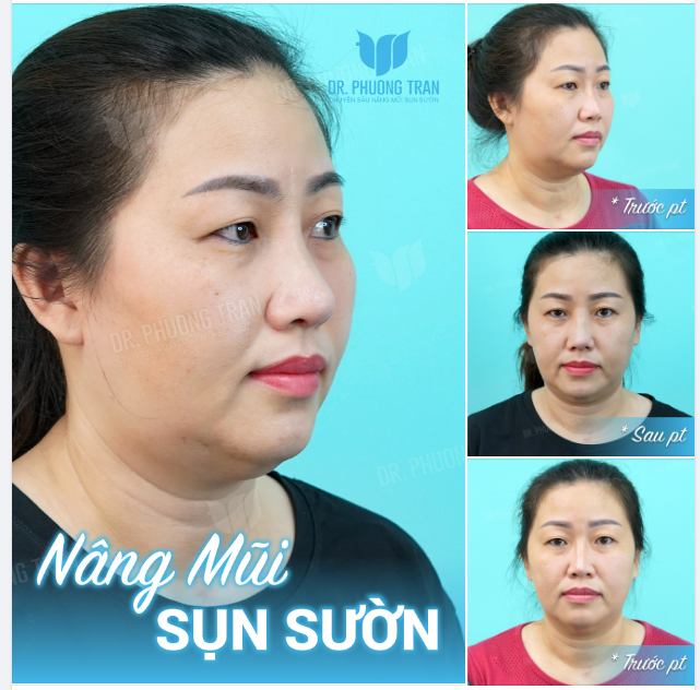 CHIẾC MŨI MÉO LỆCH, LỘ SỐNG VÌ CHỌN SAI KÍCH THƯỚC SỤN
