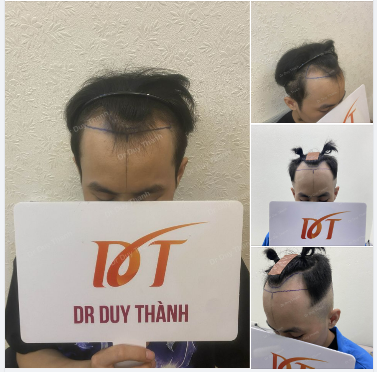 CHUẨN BỊ CẤY 1200 NANG TÓC CHO BOY HÀ TĨNH