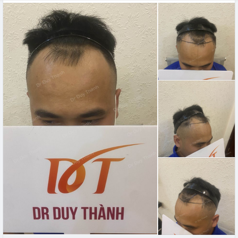 CHUẨN BỊ CẤY 1300 NANG TÓC CHO BOY NGHỆ AN 27 TUỔI
