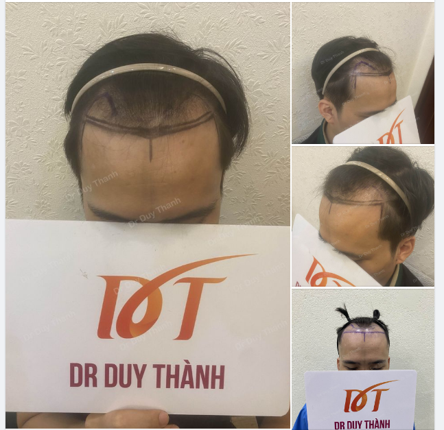 CHUẨN BỊ CẤY 1350 NANG TÓC CHO BOY HÀ NỘI 34 TUỔI