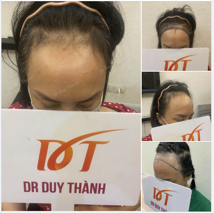 CHUẨN BỊ CẤY 1600 NANG TÓC HẠ THẤP HAIRLINE - THU NHỎ TRÁN CHO KHÁCH NỮ HÀ NỘI