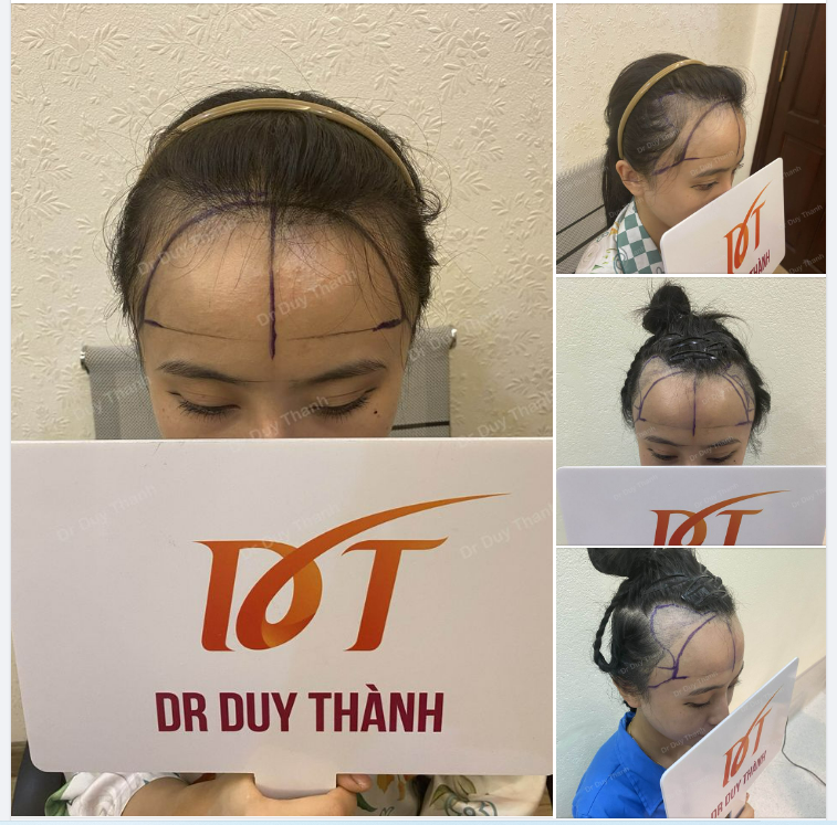 CHUẨN BỊ CẤY 1700 NANG TÓC HẠ THẤP HAIRLINE CHO KHÁCH NỮ HÀ NỘI