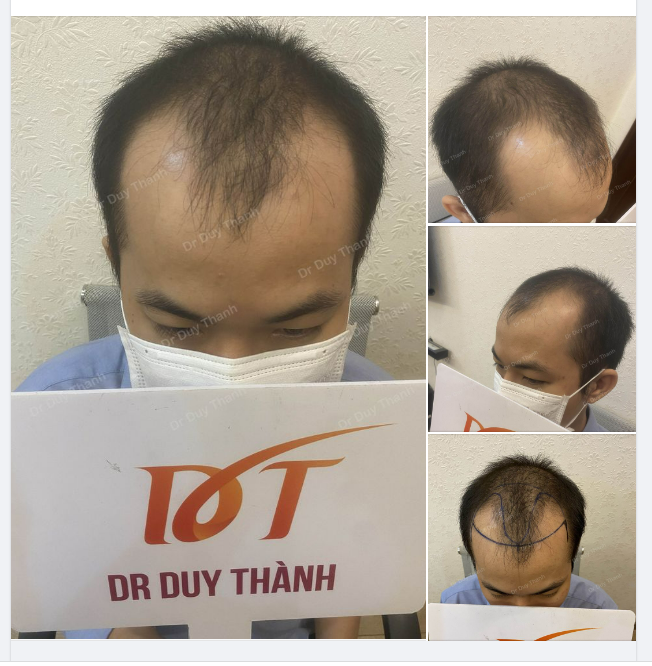 CHUẨN BỊ CẤY 1900 NANG TÓC CHO BOY VŨNG TÀU 28 TUỔI