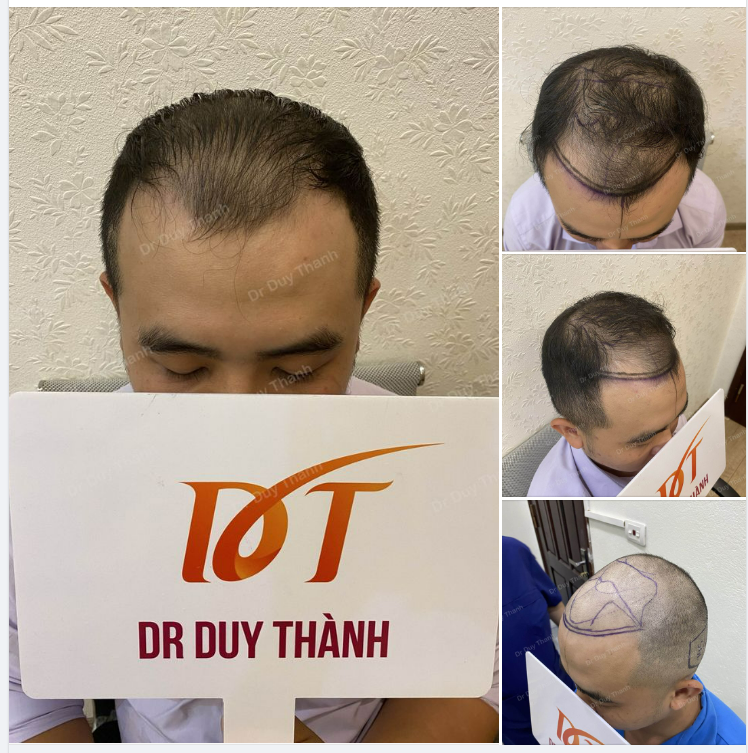 CHUẨN BỊ CẤY 1940 NANG TÓC CHO BOY PHÚ THỌ 28 TUỔI