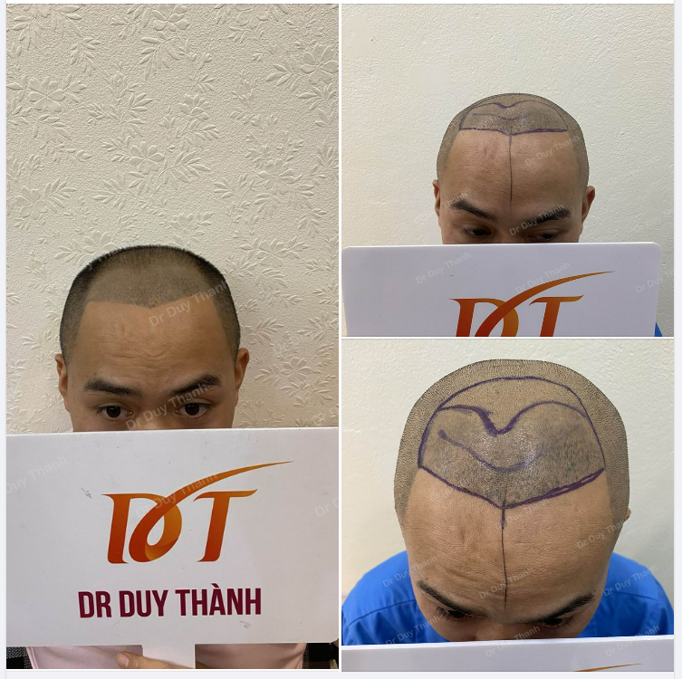 CHUẨN BỊ CẤY 2000 NANG TÓC KHÁCH HÀNG NAM 33 TUỔI- LAI CHÂU