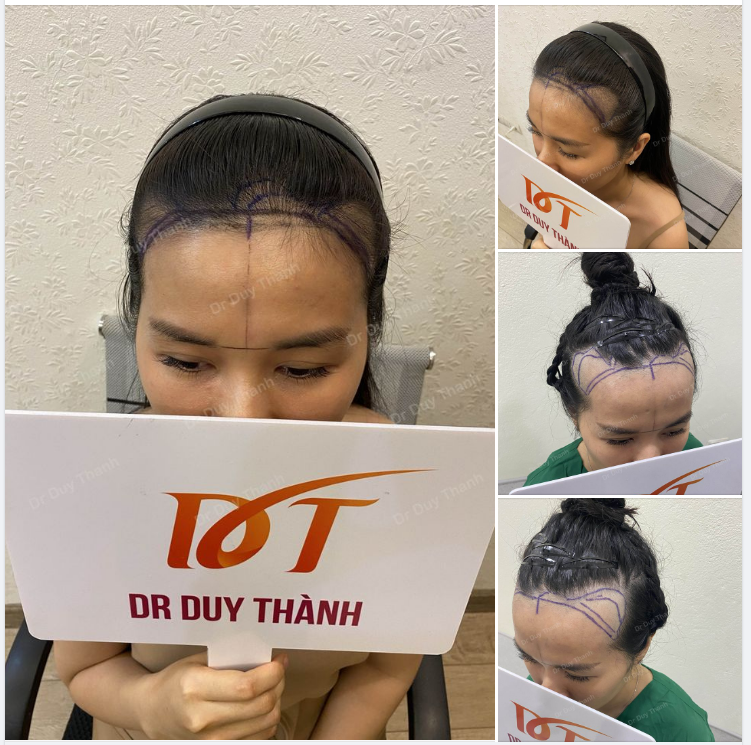 CHUẨN BỊ CẤY TÓC CHO BẠN NỮ MUỐN THIẾT KẾ LẠI ĐƯỜNG HAIRLINE VÀ LÀM DÀY TÓC VÙNG THÁI DƯƠNG.