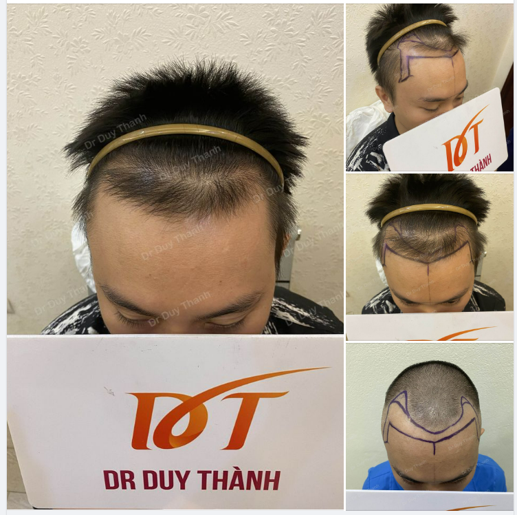 CHUẨN BỊ CẤY TÓC DHI 1600 NANG TÓC CHO BOY TP.HCM, 31 TUỔI