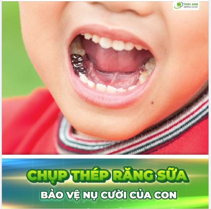 CHỤP THÉP RĂNG SỮA - BẢO VỆ NỤ CƯỜI CHO CON