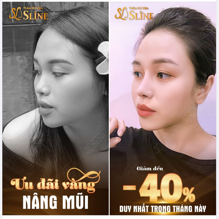 CƠ HỘI “sở hữu dáng mũi đẹp vạn người mê”
