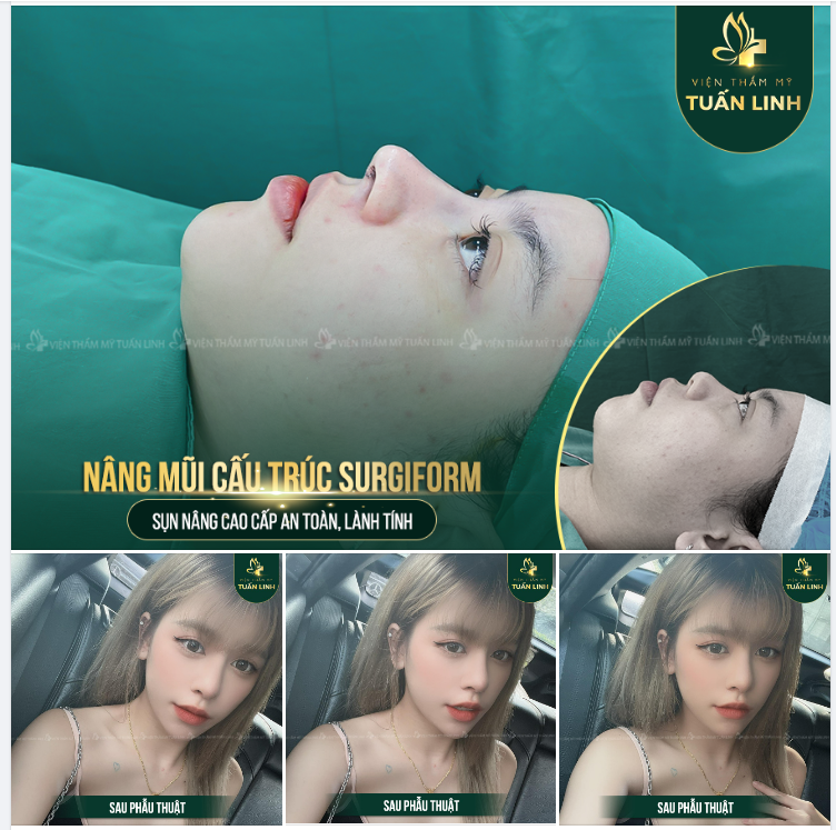 CÔ NÀNG 9X THAY ĐỔI BẤT NGỜ SAU NÂNG MŨI