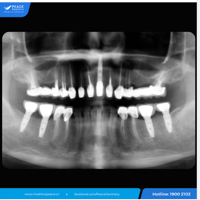 Cô vui mừng chia sẻ: “Khi trồng răng implant tôi cảm thấy rất nhẹ nhàng, không đau nhức nhiều, khả năng ăn nhai tốt không khác gì răng thật