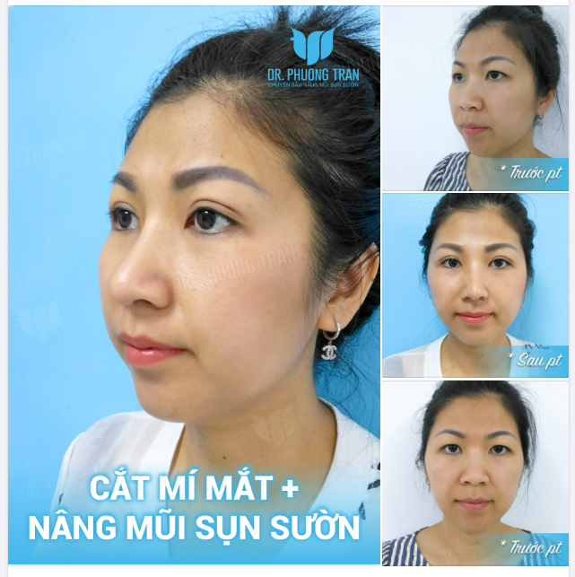 COMBO C...Ắ..T MÍ MẮT + NÂNG MŨI SỤN SƯỜN QUÁ “KHÉT” CẢ NHÀ ƠI!