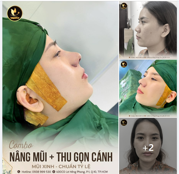 COMBO CHO DÁNG MŨI TỶ LỆ VÀNG NÂNG MŨI CẤU TRÚC KẾT HỢP CẮT CÁNH MŨI
