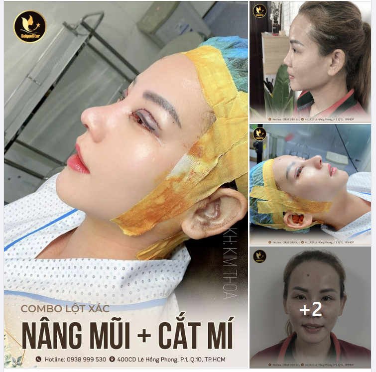 COMBO LỘT XÁC NÂNG MŨI + CẮT MÍ