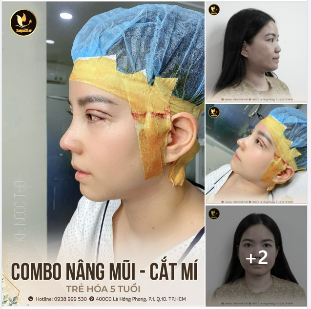 COMBO TRẺ HÓA 5 TUỔI NÂNG MŨI + CẮT MÍ