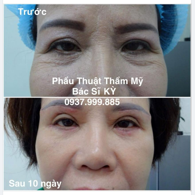 COMBO TREO CUNG MÀY Và CẮT MÍ DƯỚI CỦA Bác Sĩ KỲ