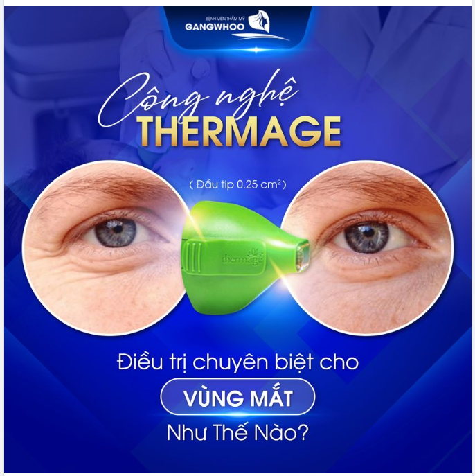 CÔNG NGHỆ THERMAGE ĐIỀU TRỊ CHUYÊN BIỆT CHO VÙNG MẮT NHƯ THẾ NÀO?