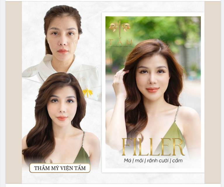 “CÔNG THỨC” CHO MỘT VẺ ĐẸP HOÀN HẢO - Combo Filler Má – Môi - Rãnh cười – Cằm