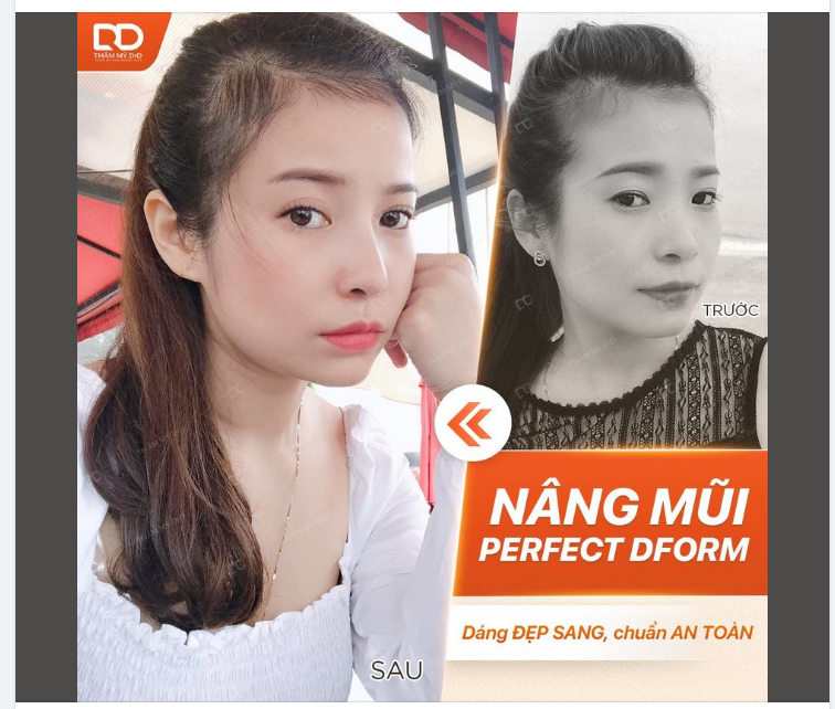 CÙNG MỘT GÓC MẶT NHƯNG LẠI ĐẸP SANG HƠN SAU NÂNG MŨI PERFECT DFORM