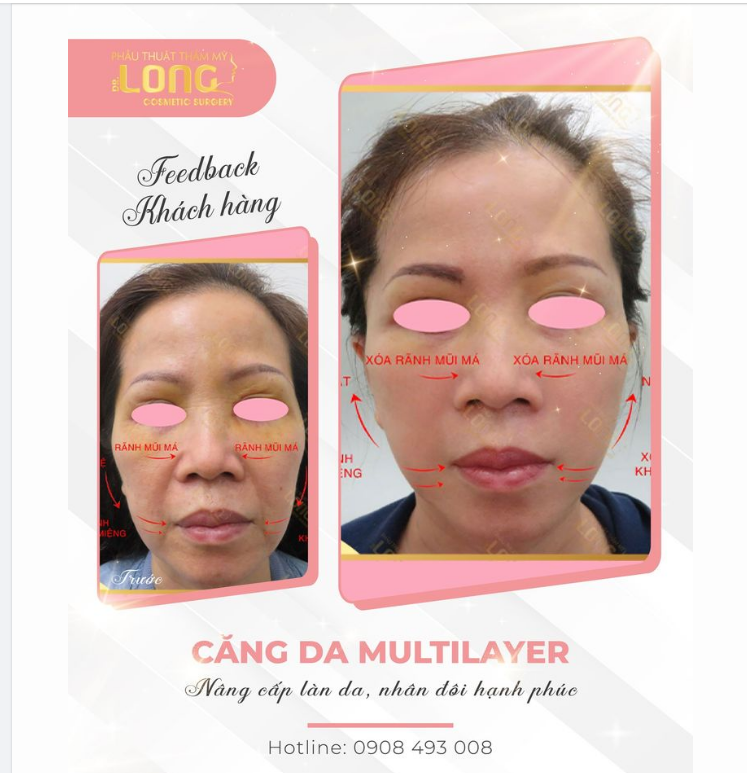Cuộc chiến thanh xuân của một khách hàng thân thiết. Kết quả thay đổi bất ngờ, toàn bộ gương mặt được hồi xuân một cách ngoạn mục chỉ sau hơn 60 phút