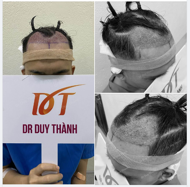 ĐÃ CẤY XONG 1350 NANG TÓC CHO BOY HÀ NỘI 34 TUỔI