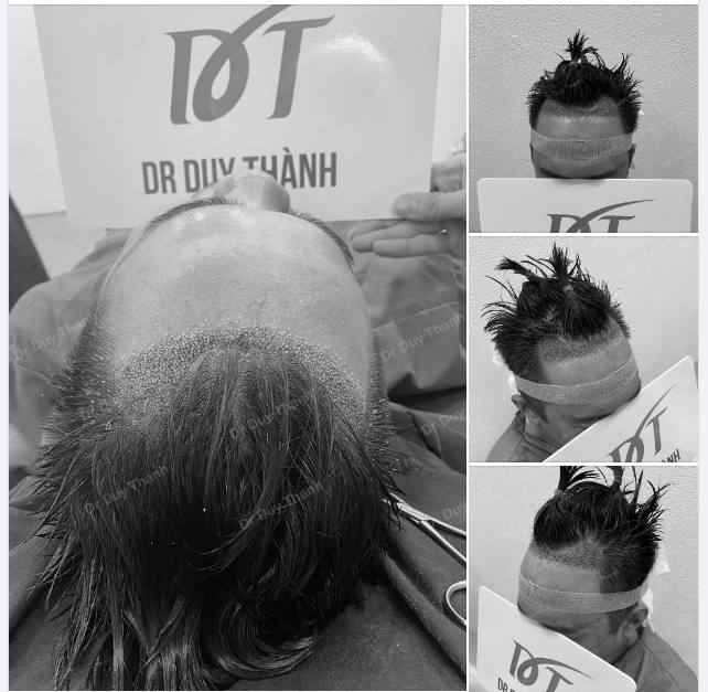 ĐÃ CẤY XONG 900 NANG TÓC CHO KHÁCH HÀNG NAM TỪ VĨNH PHÚC
