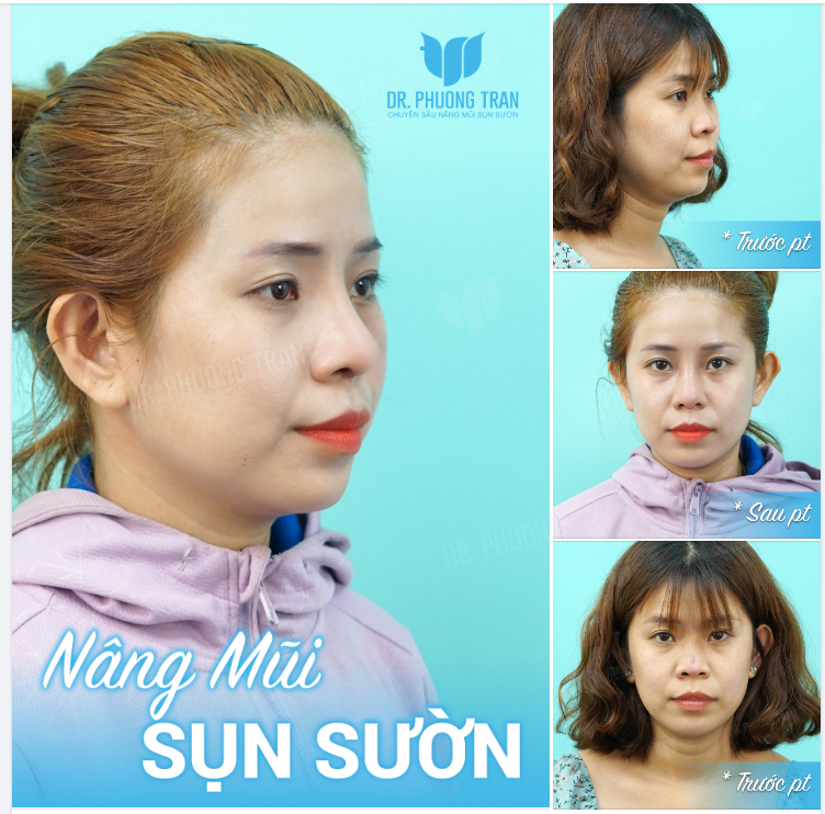 Đã Không Nâng Thì Thôi, Còn Nâng Thì Làm Luôn Mũi Sụn Sườn Cho An Tâm
