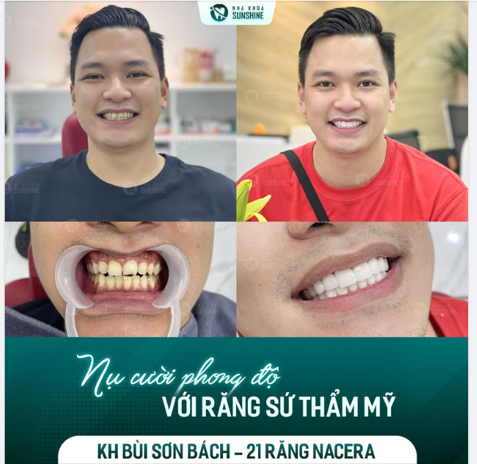 ĐÃ LÀM RĂNG LÀ PHẢI BẢO TỒN RĂNG GỐC