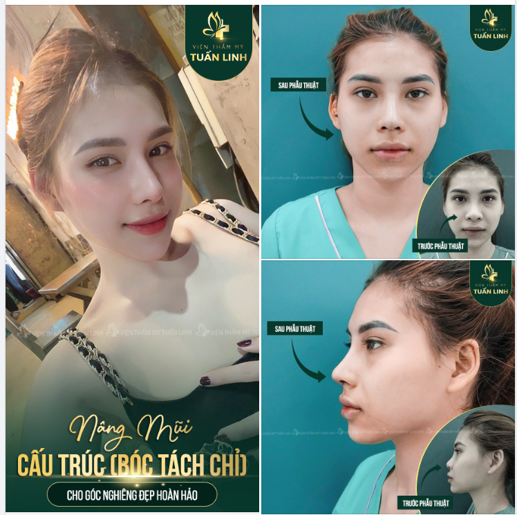 ĐÃ TỪNG NÂNG MŨI CHỈ NHƯNG KHÔNG ƯNG Ý...