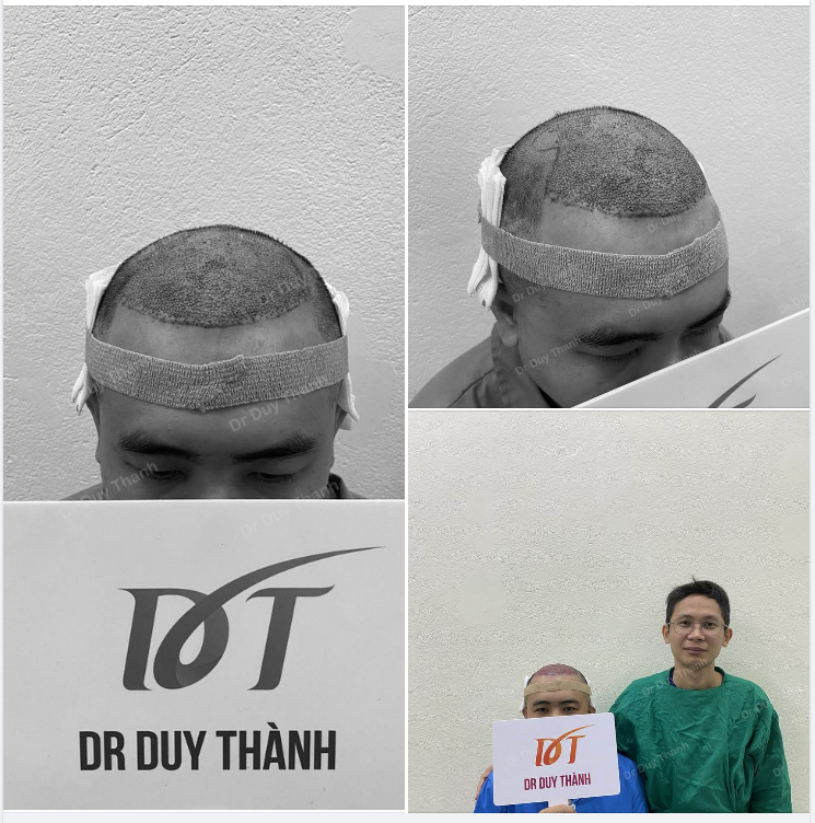 ĐÃ XONG PHIÊN CẤY 1940 NANG TÓC CHO BOY PHÚ THỌ