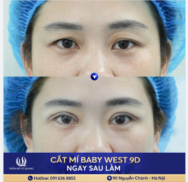 Đắn đo nhiều lần vẫn không dám làm đẹp
