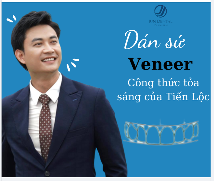 Dán sứ Veneer công thức tỏa sáng của diễn viên Tiến Lộc