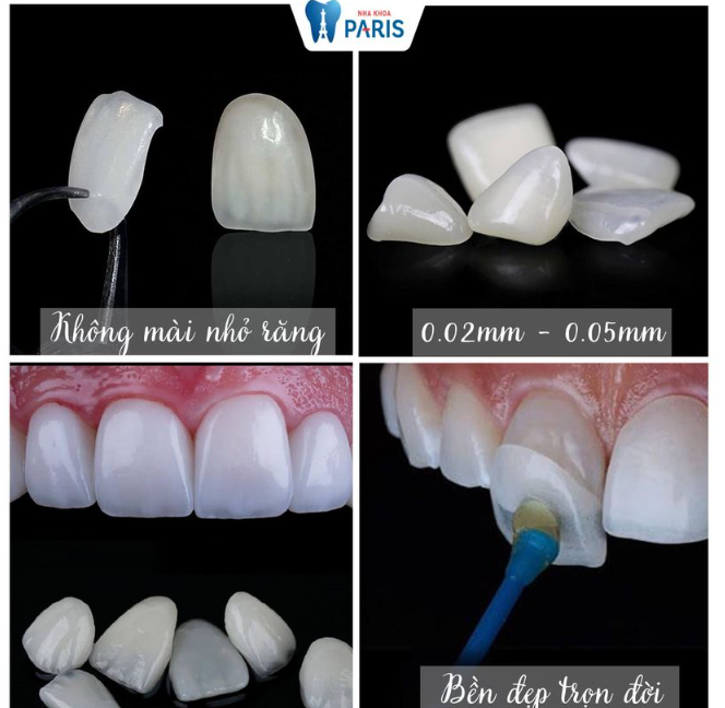DÁN SỨ VENEER - KHÔNG CẦN MÀI RĂNG