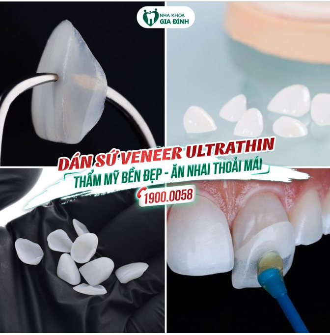 DÁN SỨ VENEER ULTRATHIN – THẨM MỸ ĐỈNH CAO, CHO NỤ CƯỜI RẠNG RỠ