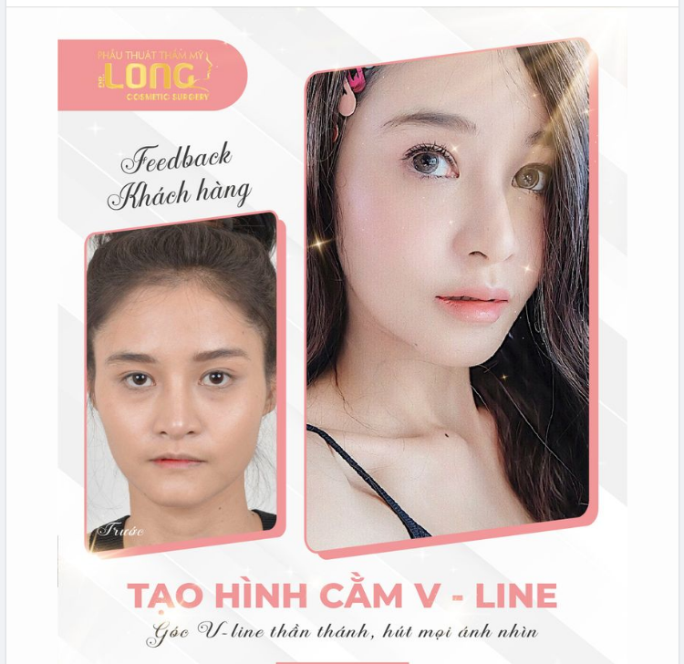 Dáng cằm xinh tôn nhan sắc giúp nàng thêm tự tin khi sở hữu cằm V-line thon gọn bất ngờ chỉ sau 1 lần thực hiện