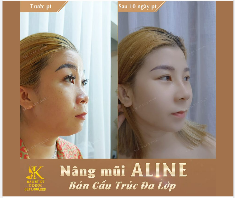 DÁNG MŨI ĐẸP LÀ DÁNG MŨI HÀI HÒA VỚI GƯƠNG MẶT.
