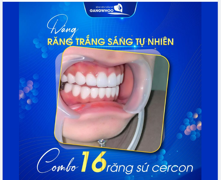 DÁNG RĂNG TRẮNG SÁNG TỰ NHIÊN CÙNG COMBO 16 RĂNG TOÀN SỨ CERCON