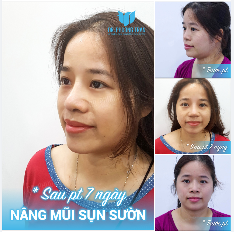 ĐÂY CHÍNH XÁC LÀ THAY MŨI GIẢ BẰNG MŨI THẬT