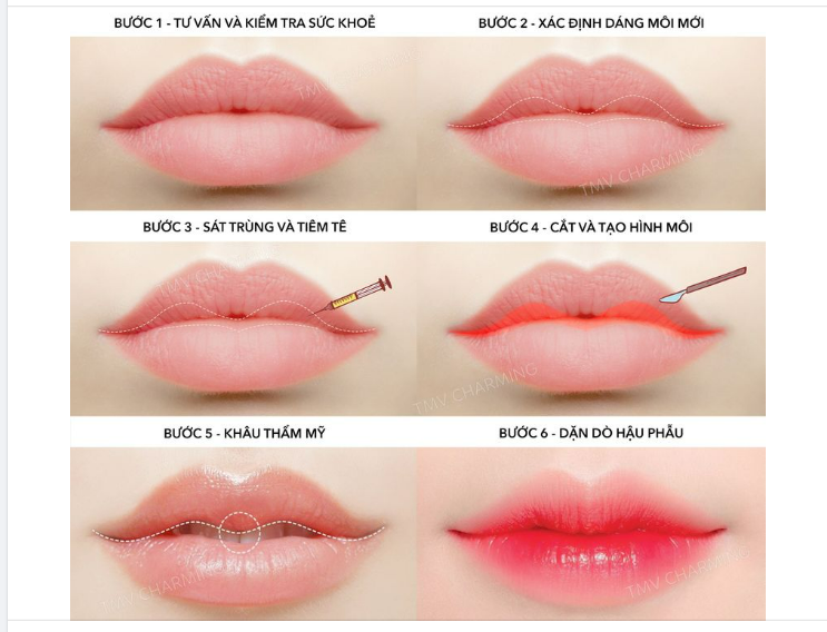 ĐIỂM QUA CÁC BƯỚC TRONG QUY TRÌNH CẮT MÔI